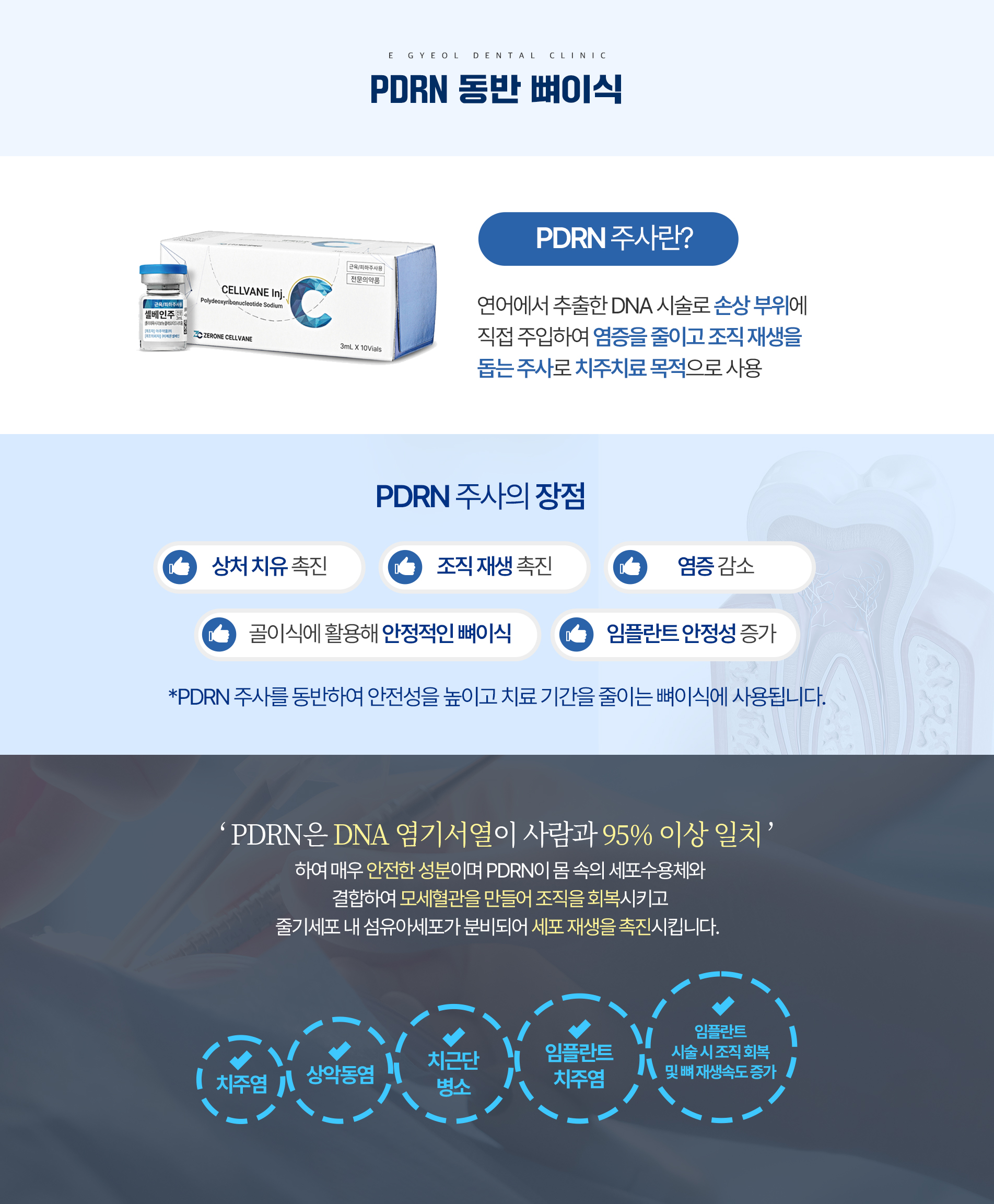 PDRN 동반 뼈이식