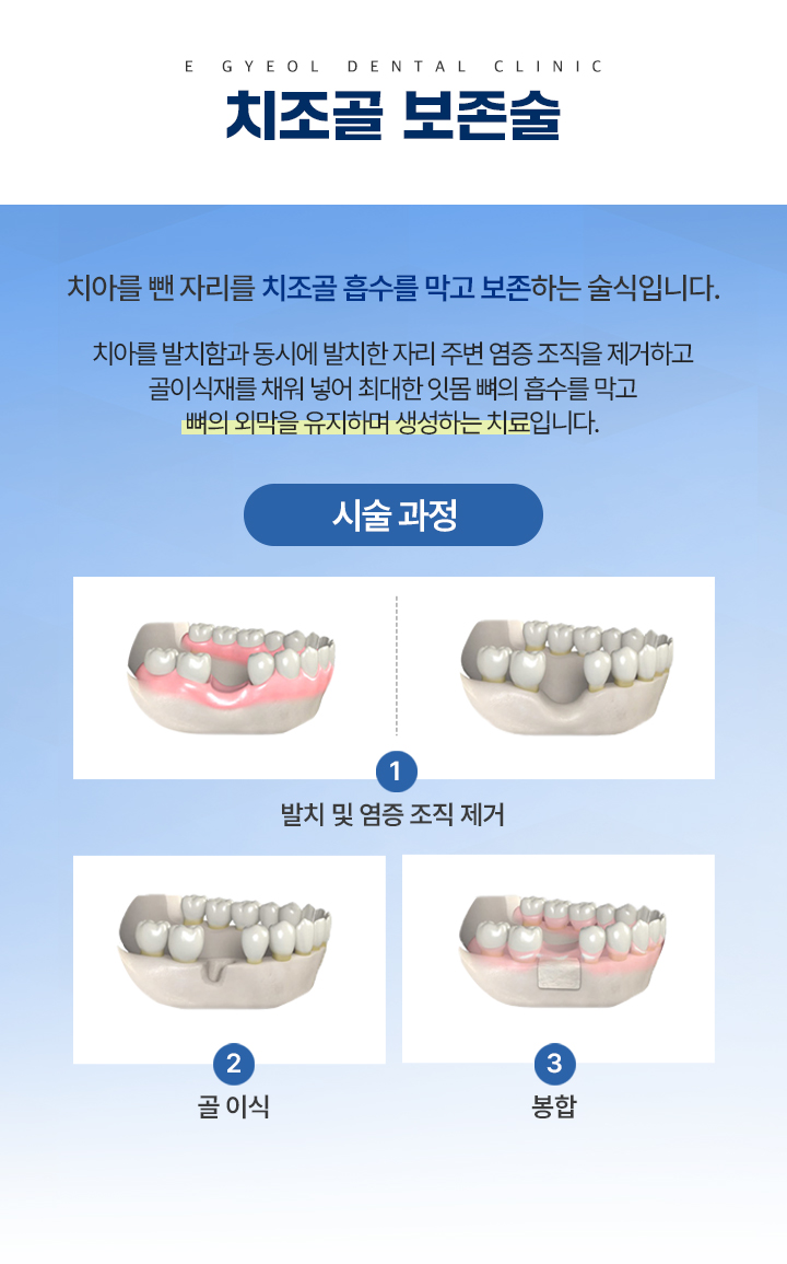 치조골 보존술