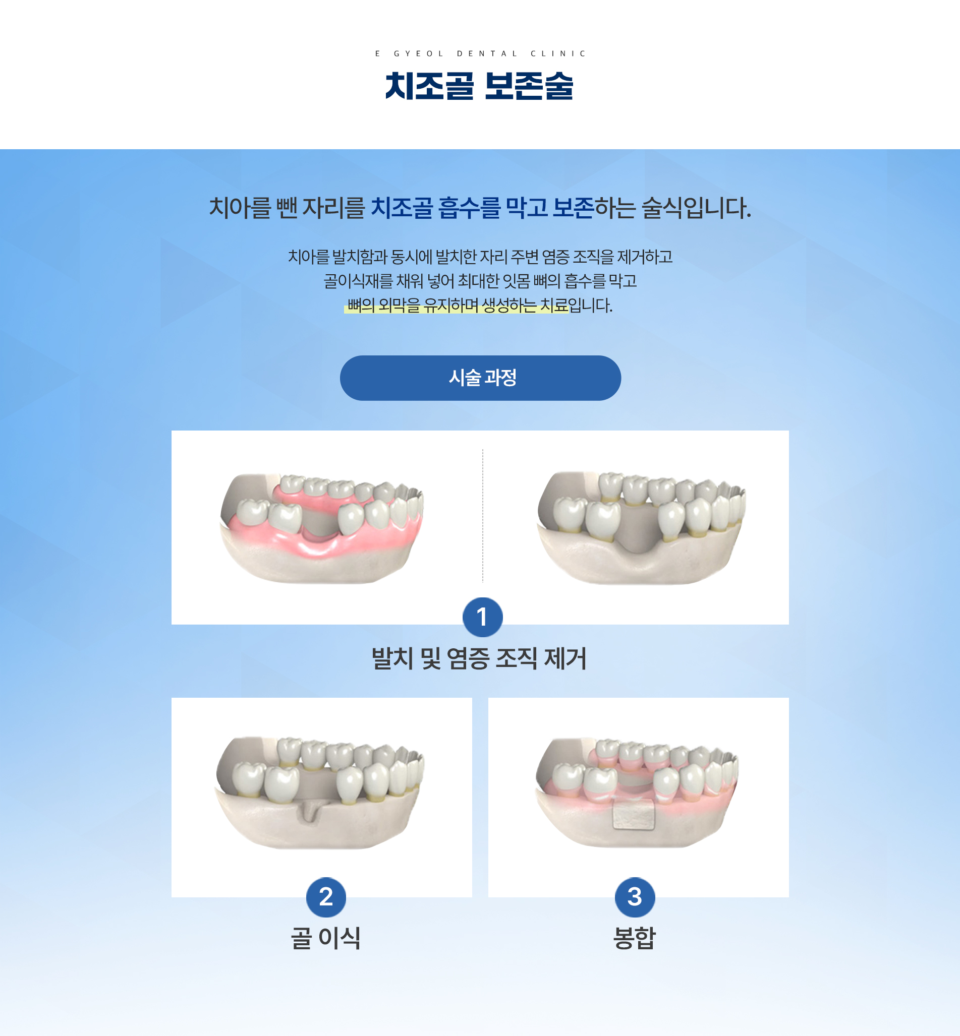 치조골 보존술